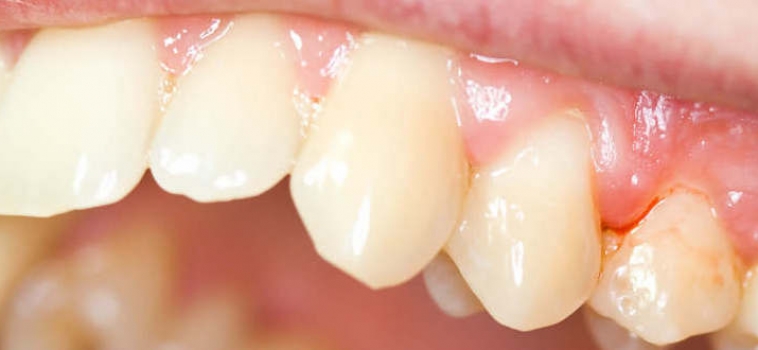 Come prevenire la gengivite e le sue conseguenze