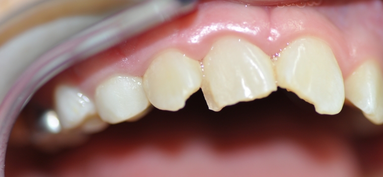Denti caduti o rotti a causa di un trauma: un danno irreparabile?