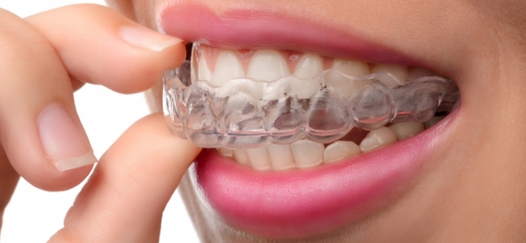 Digrignare i denti nel sonno: cause e sintomi del bruxismo