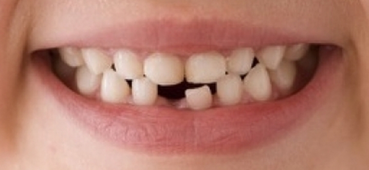 Cellule staminali dai denti da latte. Per la fatina o il topino dei denti è giunta l’ora della pensione?