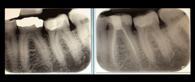 Endodonzia