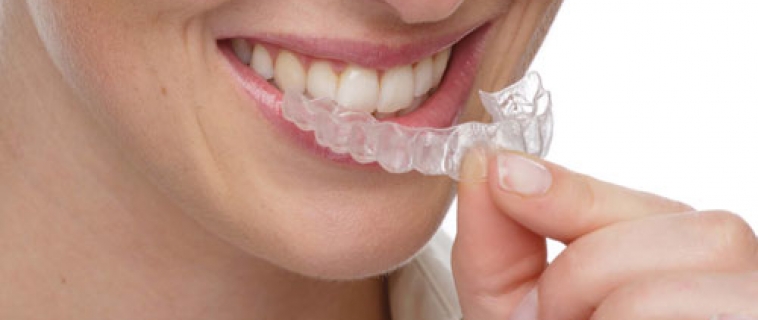 Ortodonzia e Invisalign