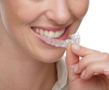 Ortodonzia e Invisalign