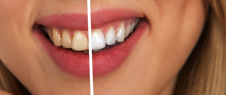 Avere denti bianchi è possibile se sai come farlo!