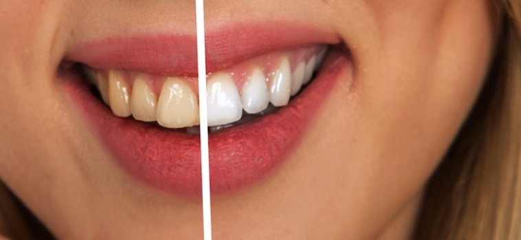 Avere denti bianchi è possibile se sai come farlo!